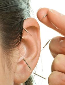 ear accupuncture