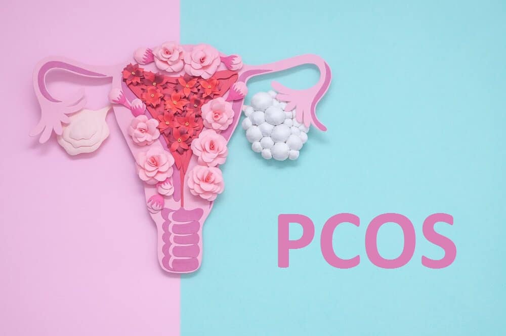 PCOS