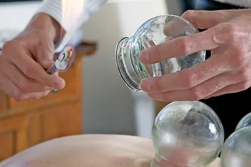 Cupping Therapy 1