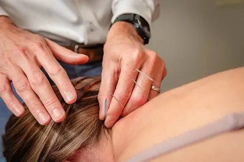 Dry Needling Neck