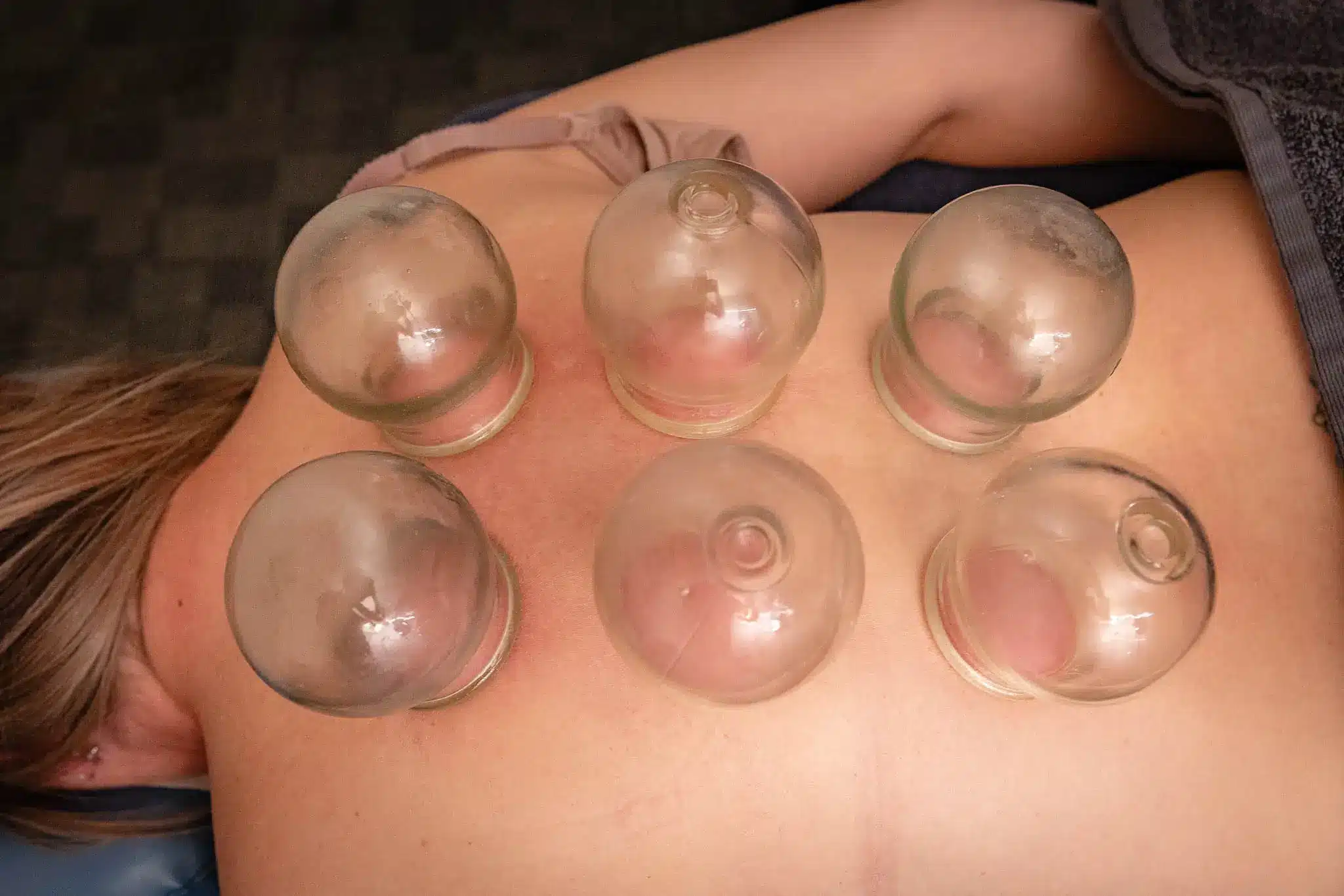 Gold Coast Cupping Treatments
