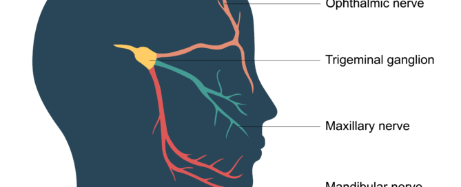 trigeminal neuralgia acupuncture gold coast