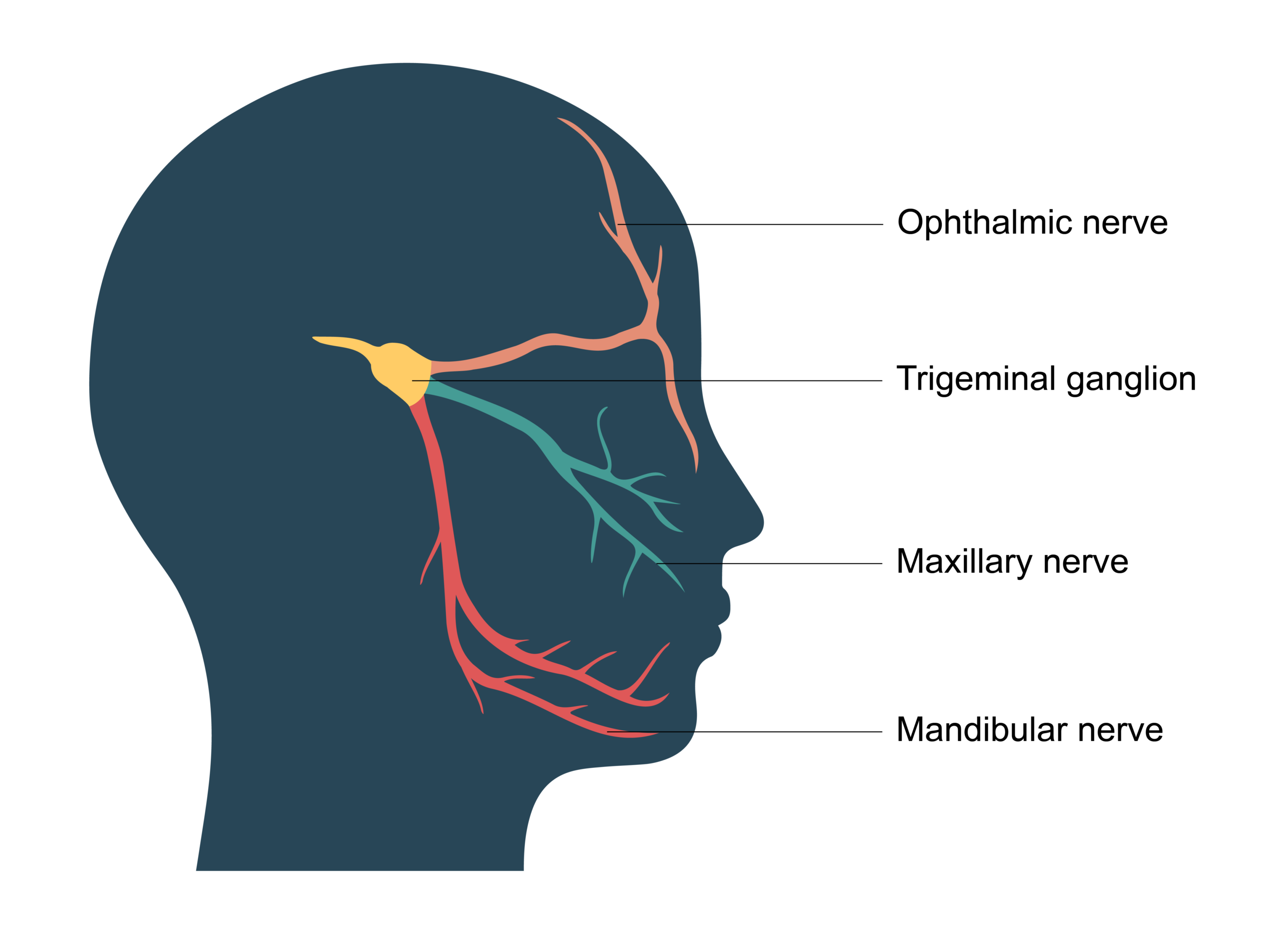 trigeminal neuralgia acupuncture gold coast