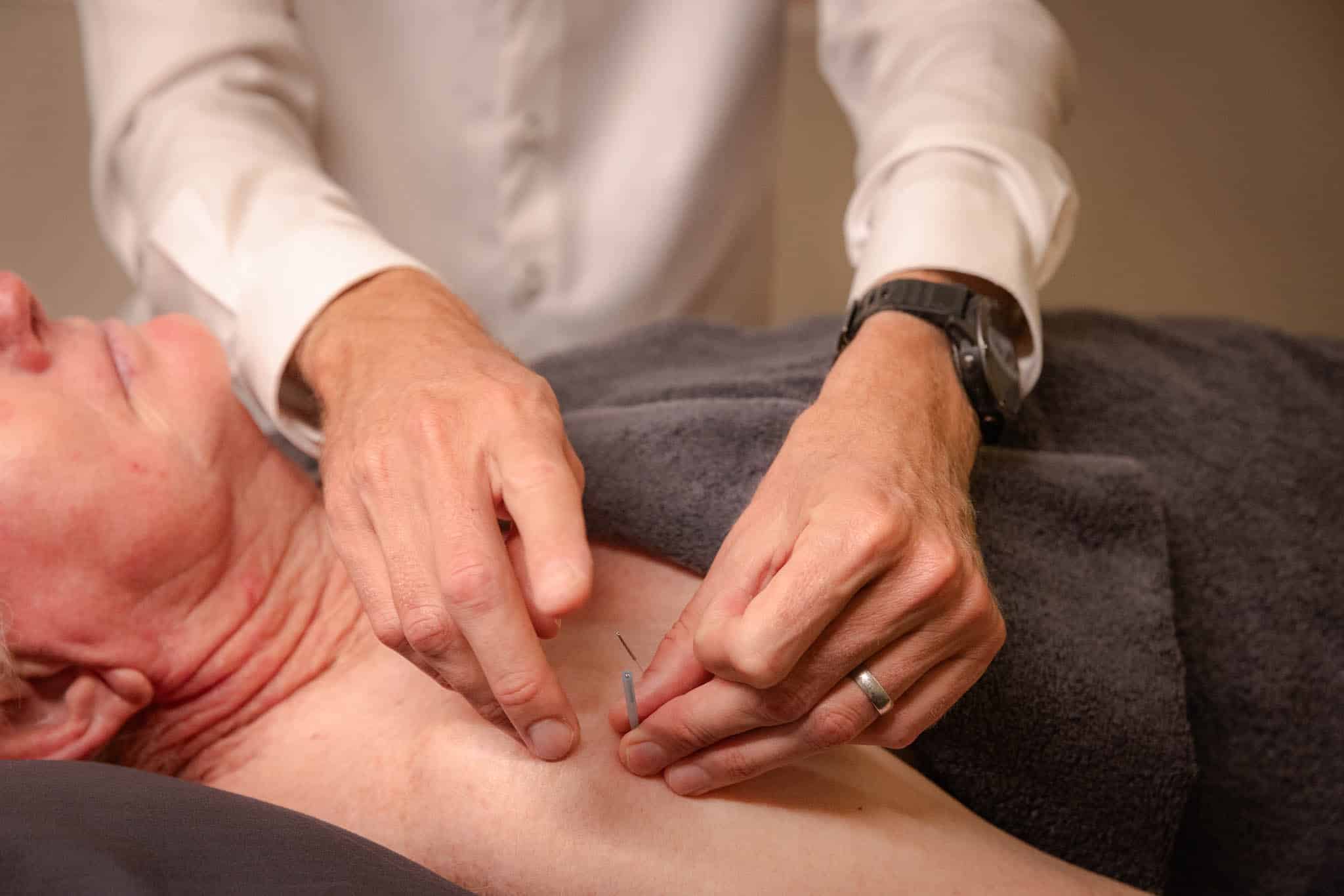 Dry needling